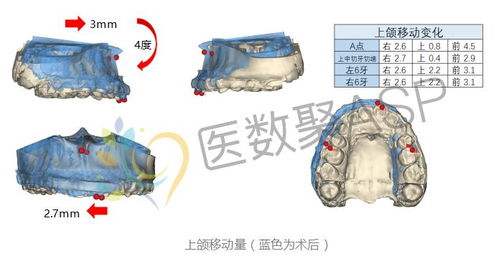 正颌手术设计方案所需时间